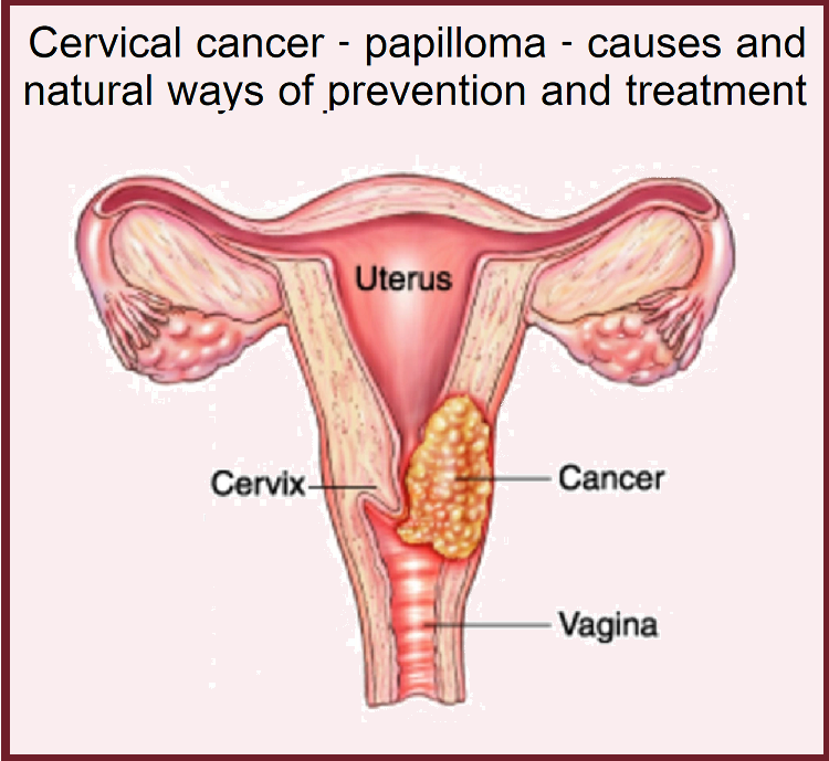 סרטן צוואר הרחם –&nbsp;פפילומה