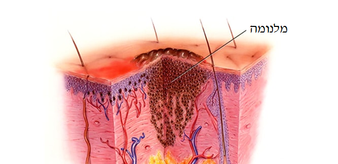 הפחד ממלנומה – האם להחשף&nbsp;לשמש?
