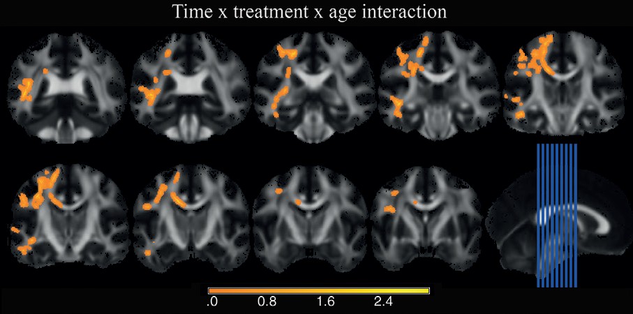 ריטלין והחומר הלבן במוח – מה קורה אחרי 16 שבועות של צריכה&nbsp;יומיומית