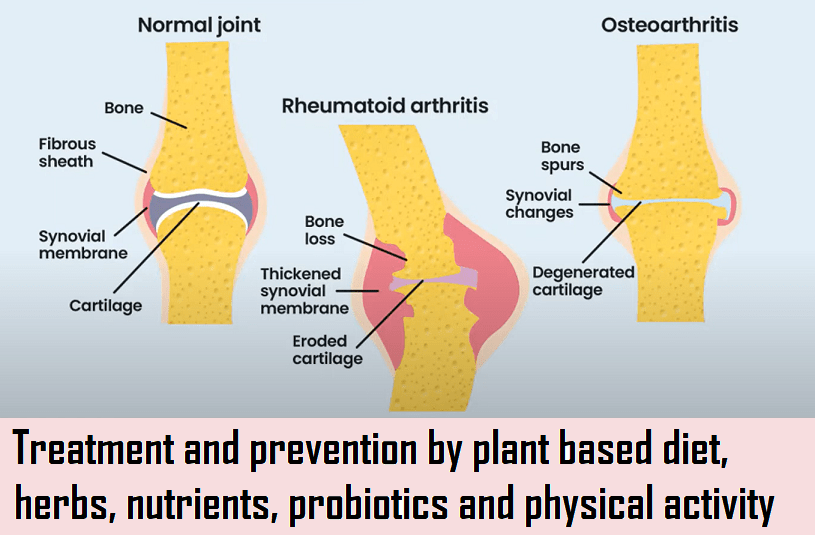 תזונה מבוססת צומח – דלקות&nbsp;פרקים