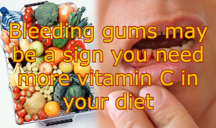 מדממים מהחניכיים? אולי חסר לכם ויטמין&nbsp;סי