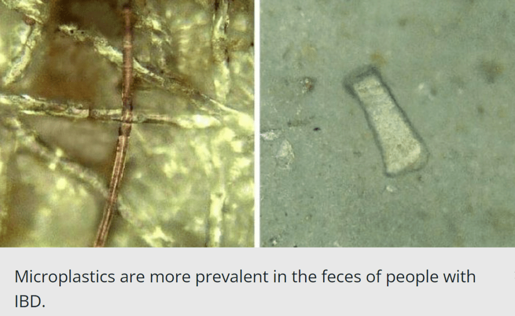 אצל אנשים עם דלקות מעי נמצא יותר מיקרופלסטיק&nbsp;בצואה