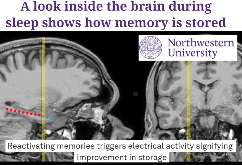 בחינת פעילות מוחית בזמן השינה אצל חולי אפילפסיה, גילתה מנגנון מענין לגבי&nbsp;זיכרון