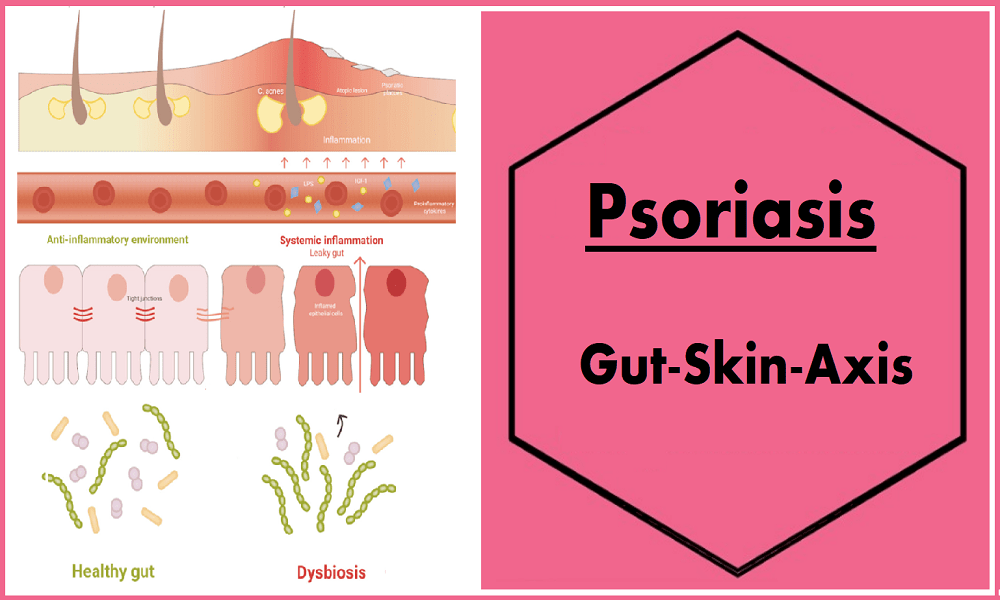 פסוריאזיס – ציר מעי&nbsp;עור